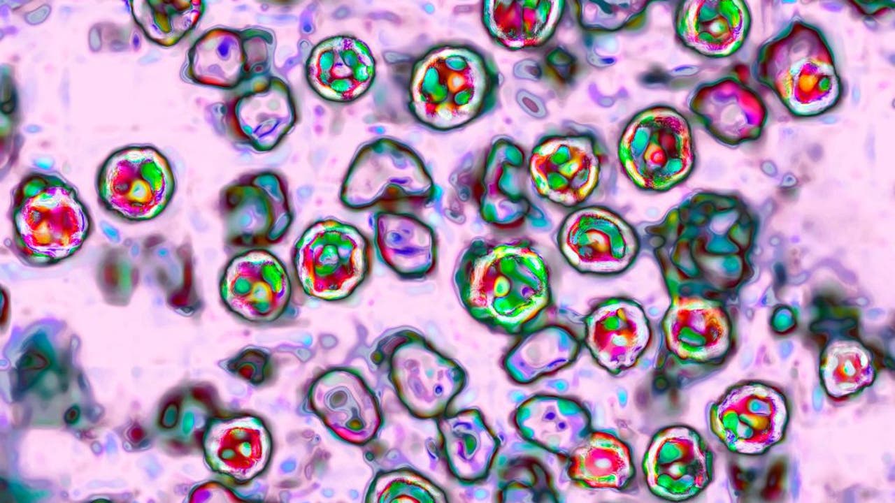 Fifth measles case confirmed in Georgia | What we know