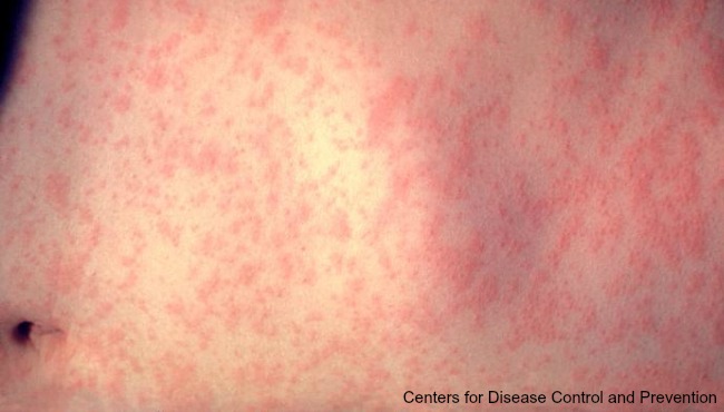 Measles case confirmed in Allegan County