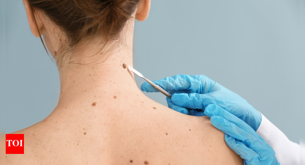 Skin Cancer Symptoms: Skin cancer or something else? 5 signs no one should ignore |