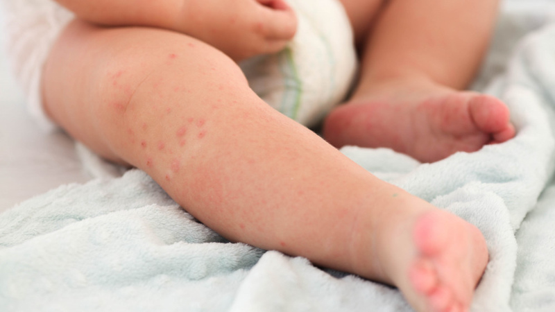 94% of children who contracted measles were not vaccinated