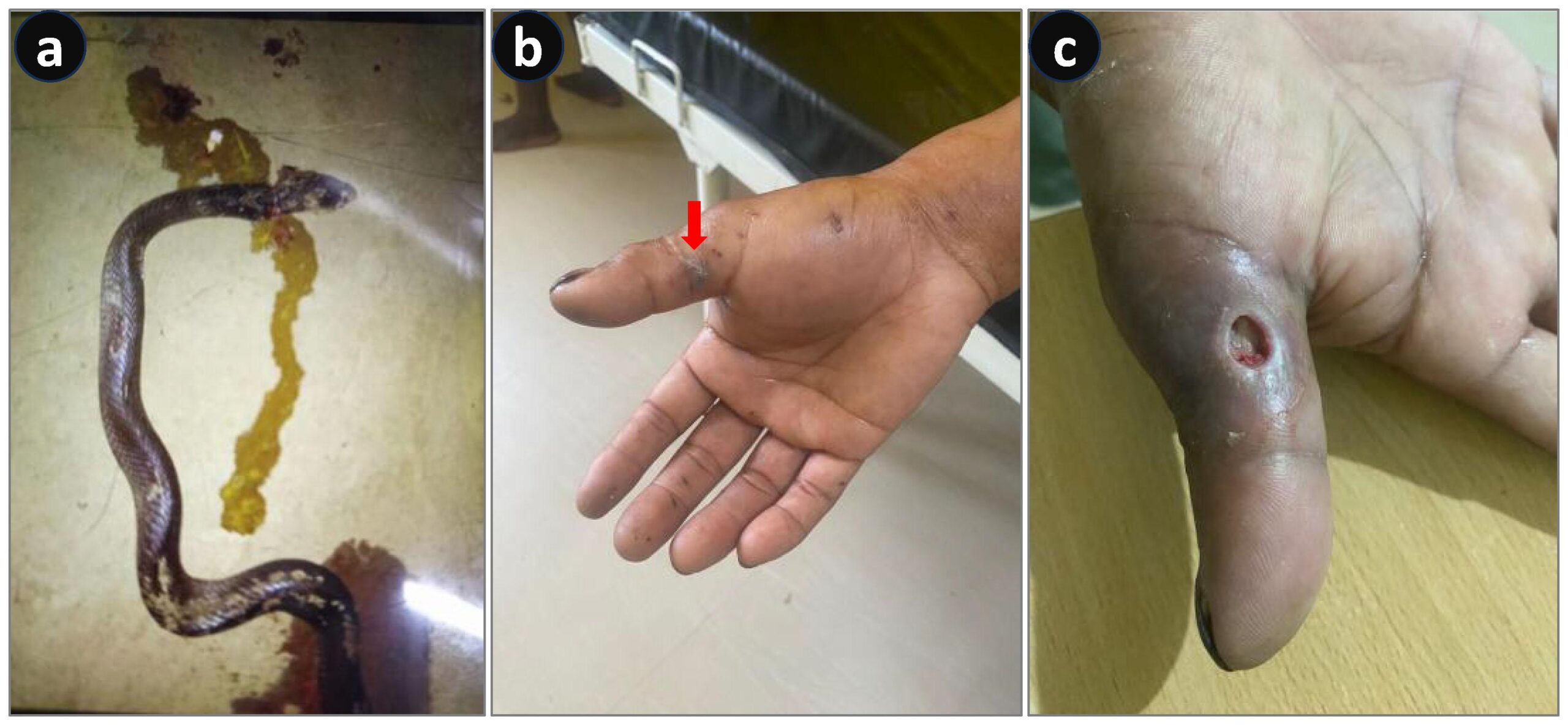Assam doctors report world’s first cases of dead cobra and krait bites