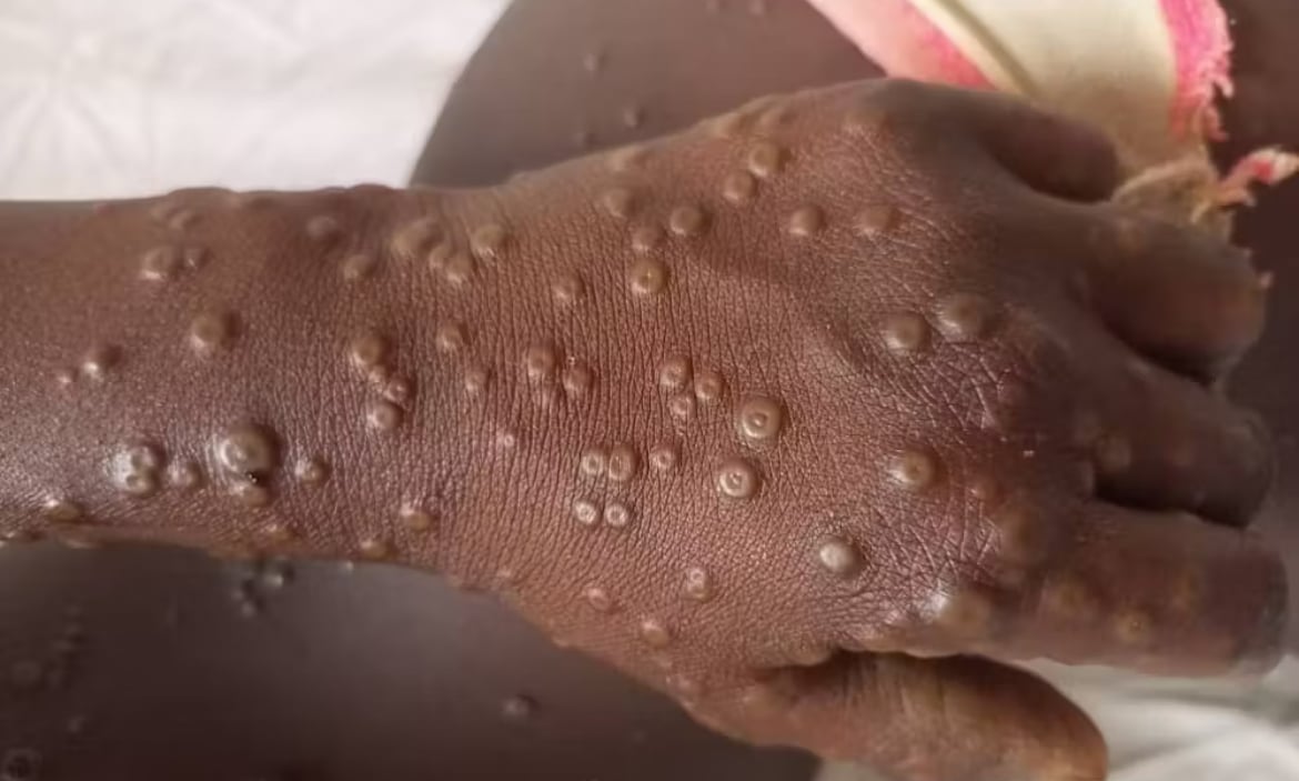 What we know about the man who introduced monkeypox to Dakar