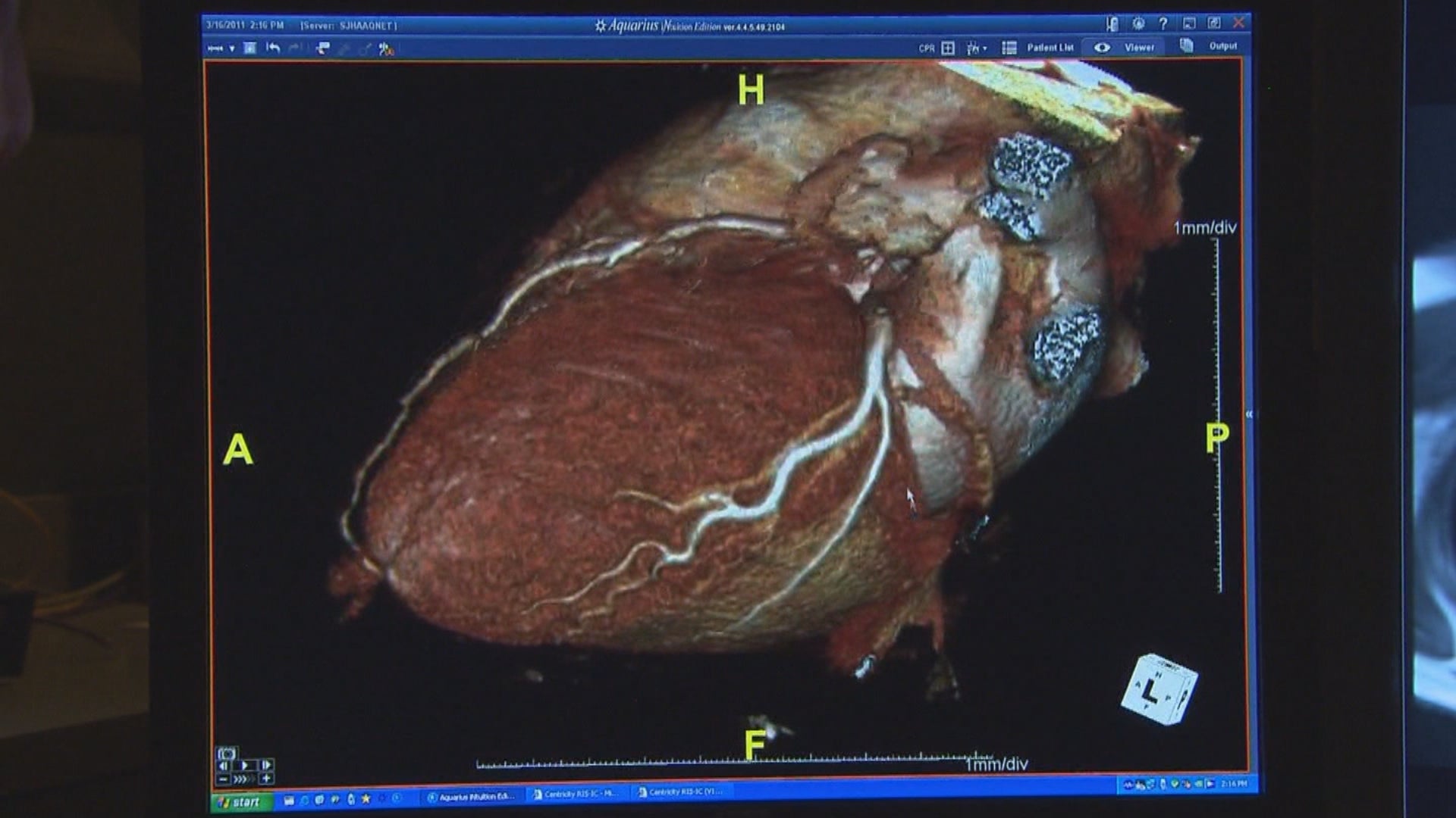 With rise in heart attacks among young adults, study highlights artery ailment - Indianapolis News | Indiana Weather | Indiana Traffic