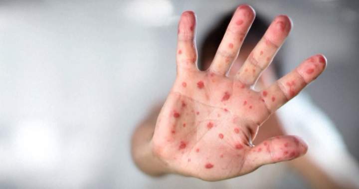 Canada could lose its status as a measles-free country amid outbreak - National
