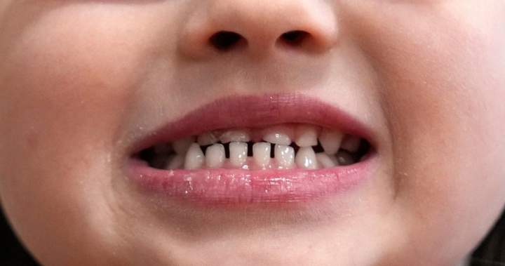 FDA restricts use of kids’ fluoride supplements citing emerging health risks - National