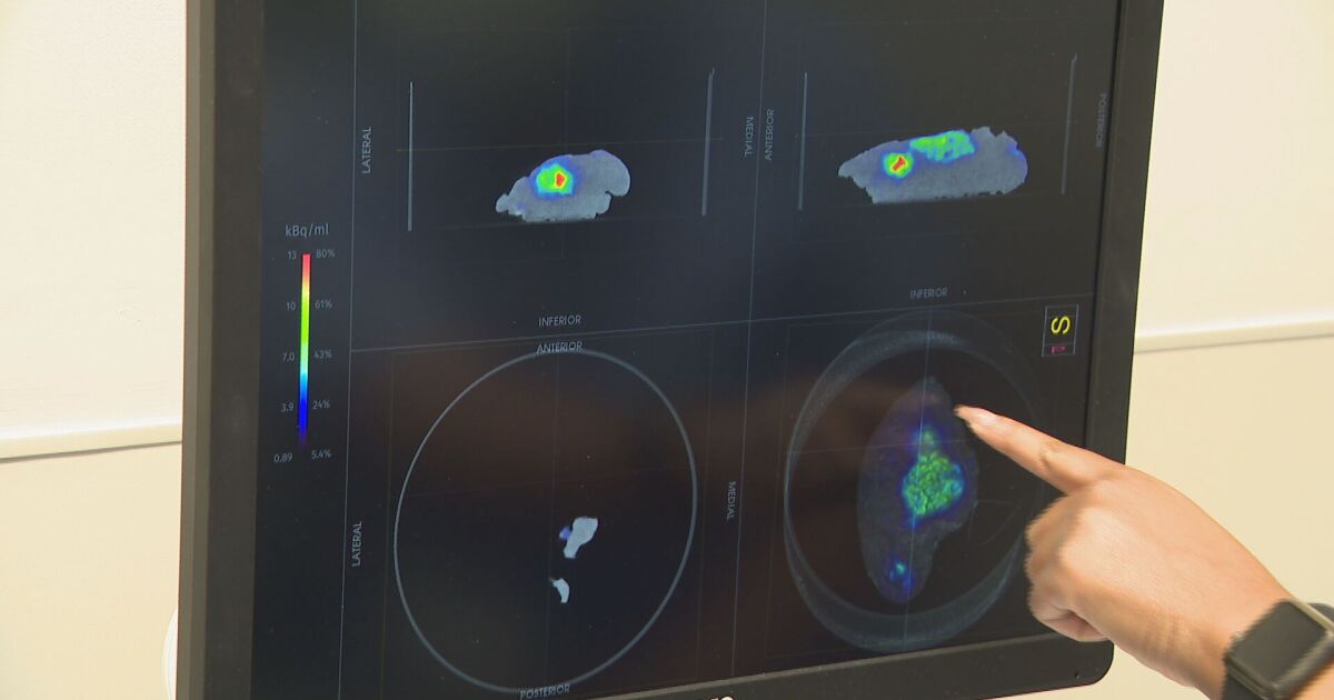 New surgery tool at Vanderbilt helps surgeons isolate, remove cancer
