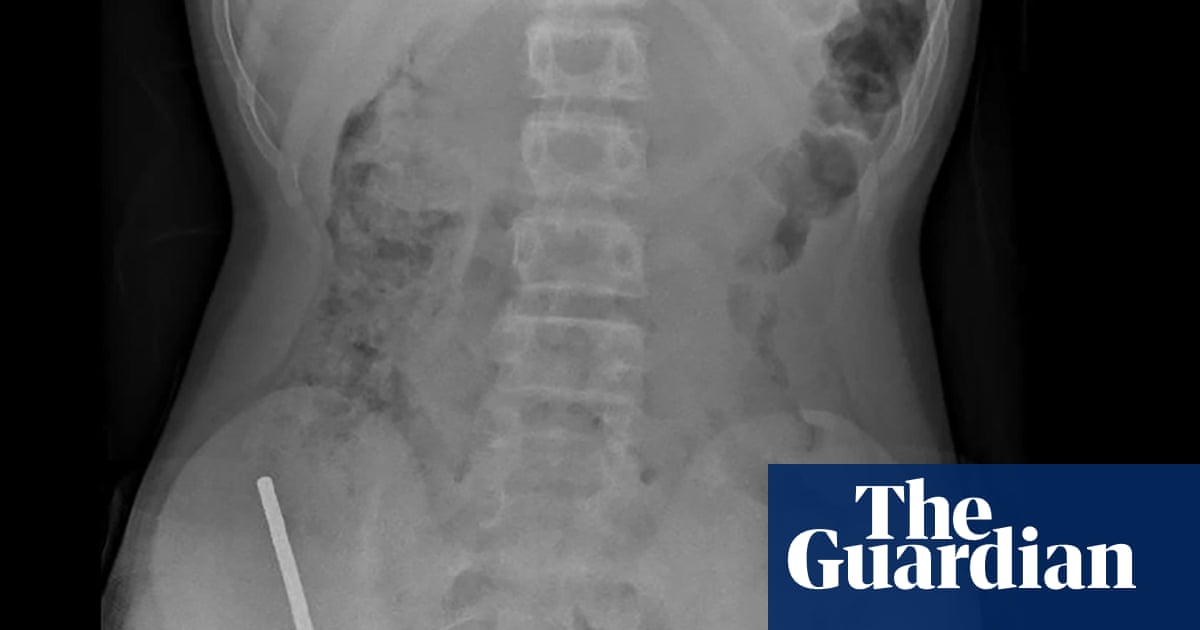 Surgeons remove high-power magnets from New Zealand teenager’s intestines | World news