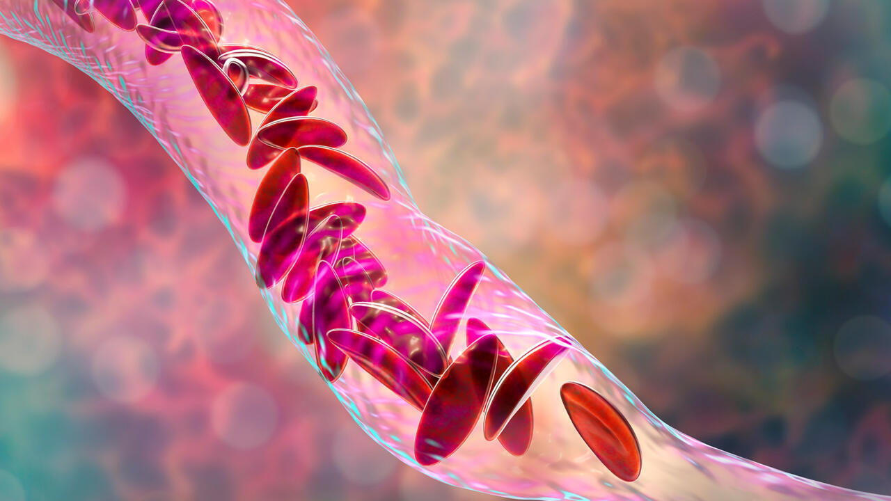 a new treatment for sickle cell disease accessible to all