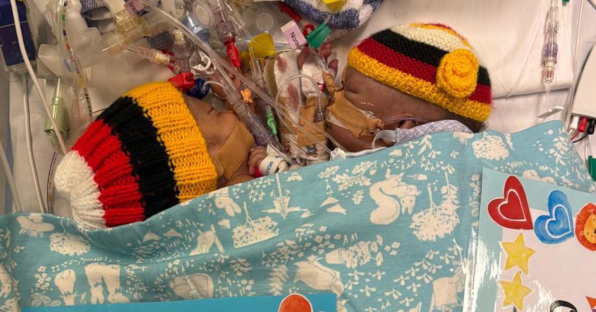 One of the conjoined twins flown from PNG dies after emergency surgery in Sydney