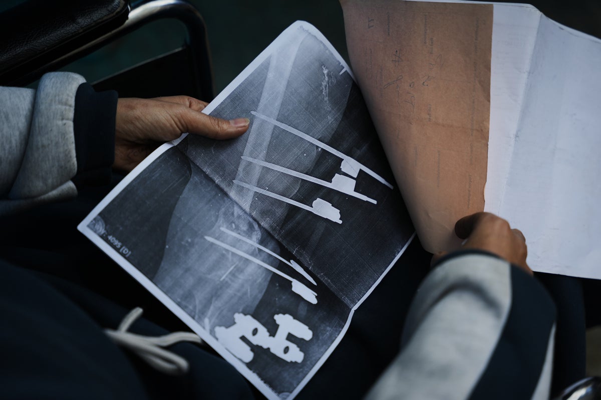 A bullet shattered her knee. Now a Gaza teen's chances of walking depend on Rafah border crossing