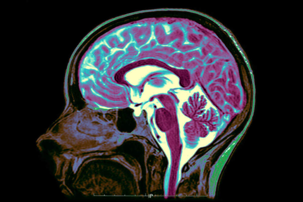 Mri T2 Of A Normal Brain. Mid Sagittal View. (Photo By BSIP/UIG Via Getty Images)