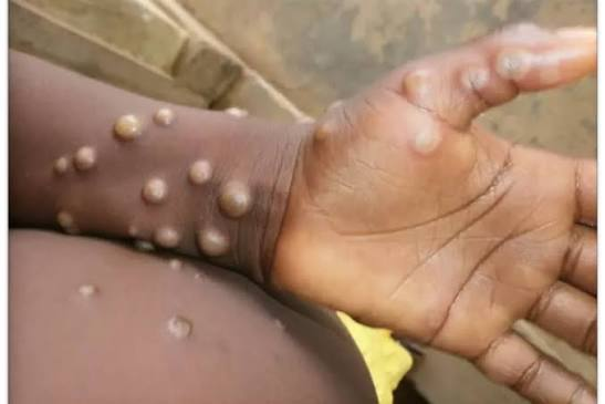 Mpox in Cameroon: 22 Confirmed Cases, No Deaths Recorded