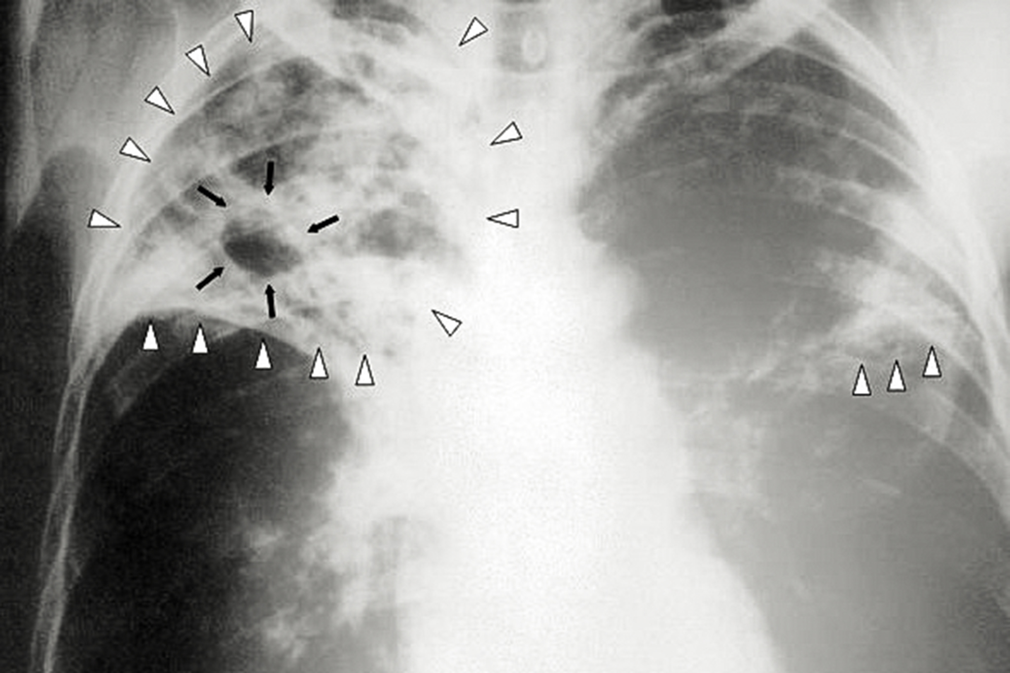 'Age-old' disease hits 12-year high in Calif. as new outbreak details