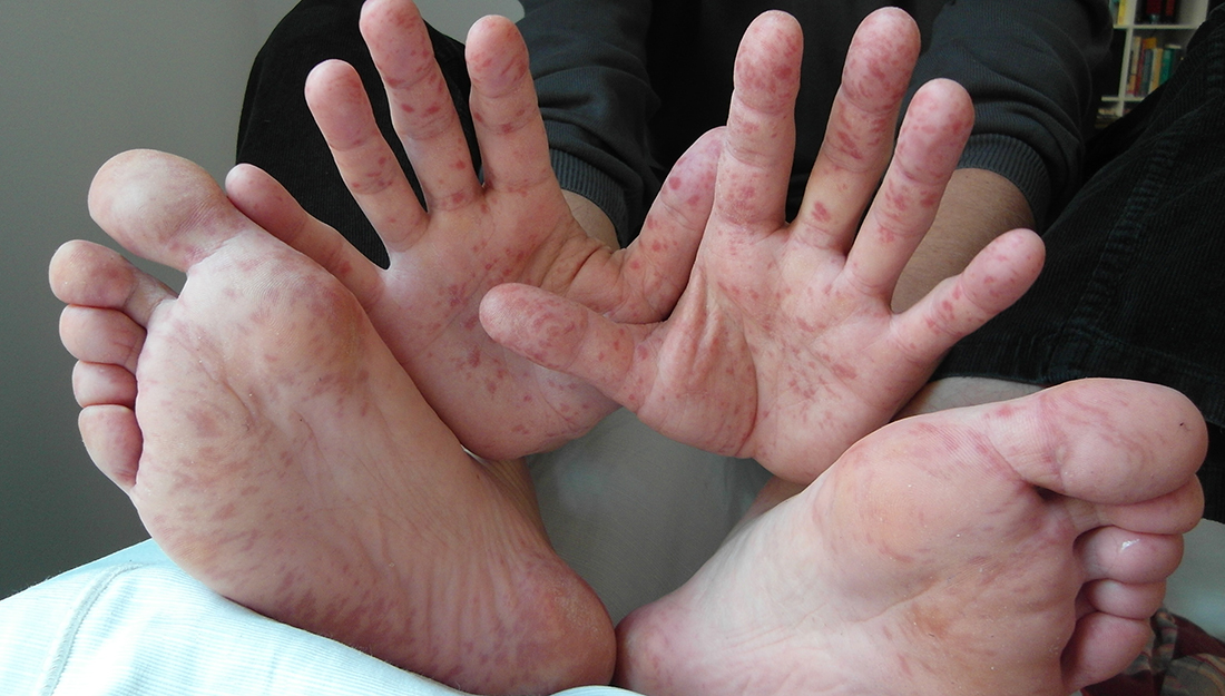 St Vincent sees rising cases of HFMD in Preschools Nationwide