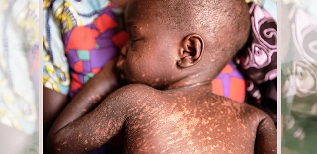 Uganda warns of rising measles cases nationwide