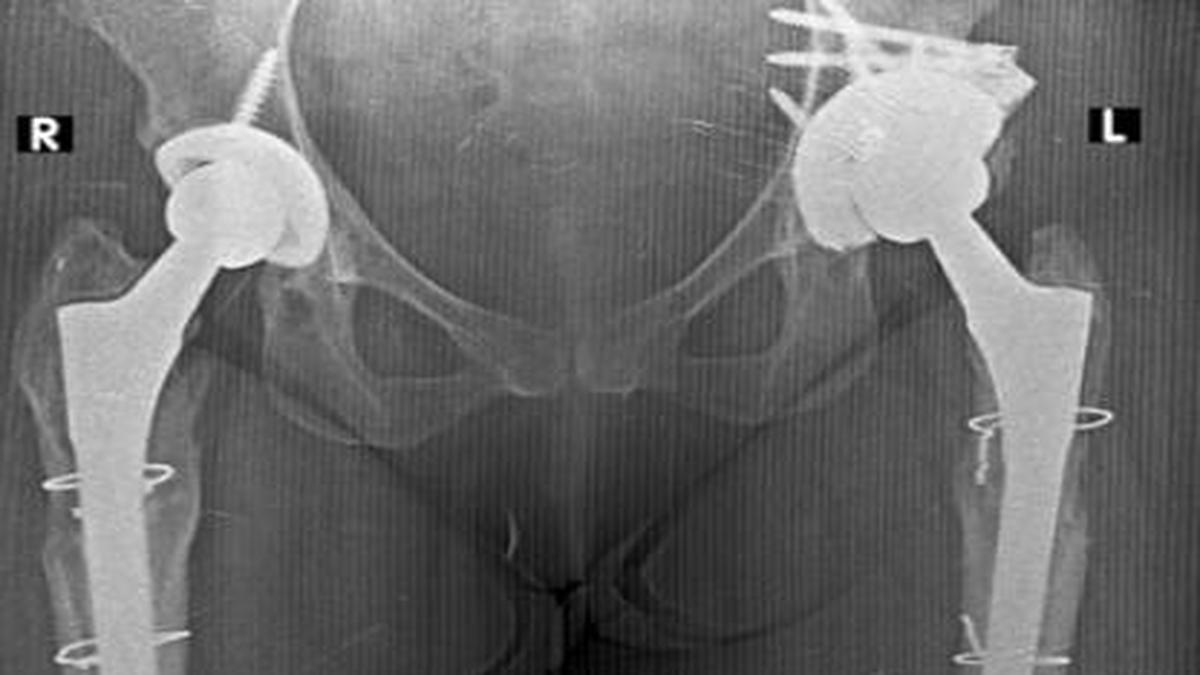 Infections, fractures increasingly driving repeat hip replacement surgeries, finds study