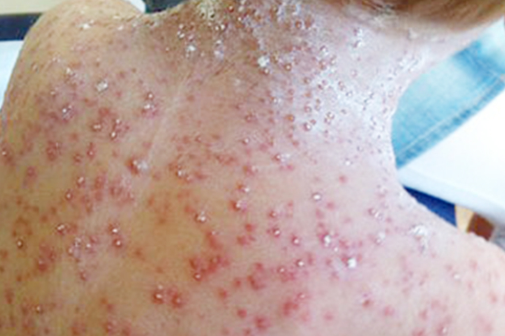 Chickenpox outbreak HMP - Searchlight