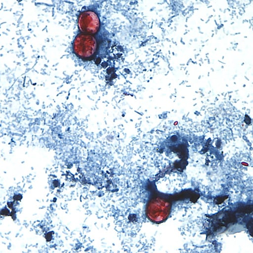 Cyclospora has reached Kearney with three cases