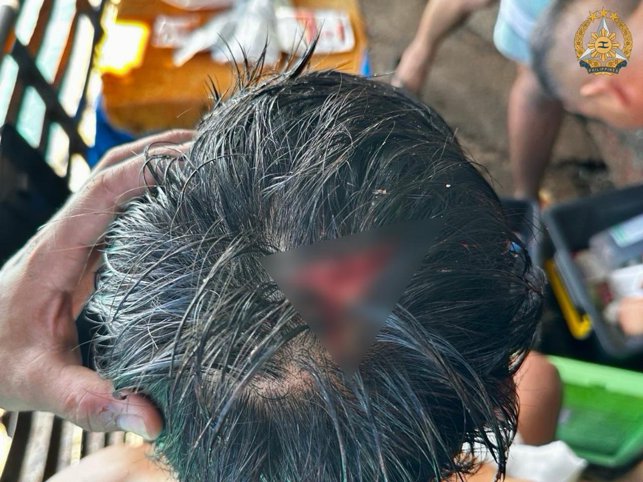 A Philippine Navy personnel suffered serious head injury after China Coast Guard personnel aggressively struck him with a wooden baton in Ayungin Shoal, West Philippine Sea on July 20.