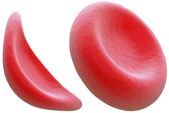 FDA approves first Gene Therapy for young children with Sickle Cell Disease