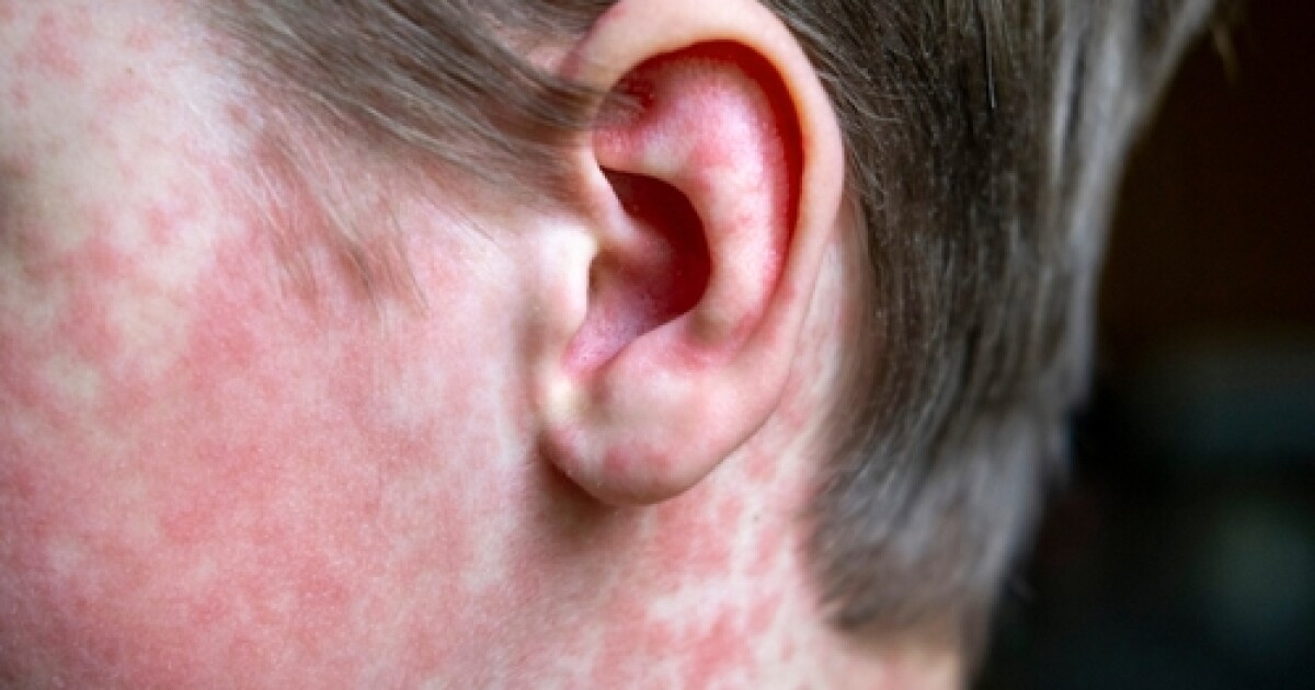 Middle Tennessee measles cases tied to Nashville, Murfreesboro sites