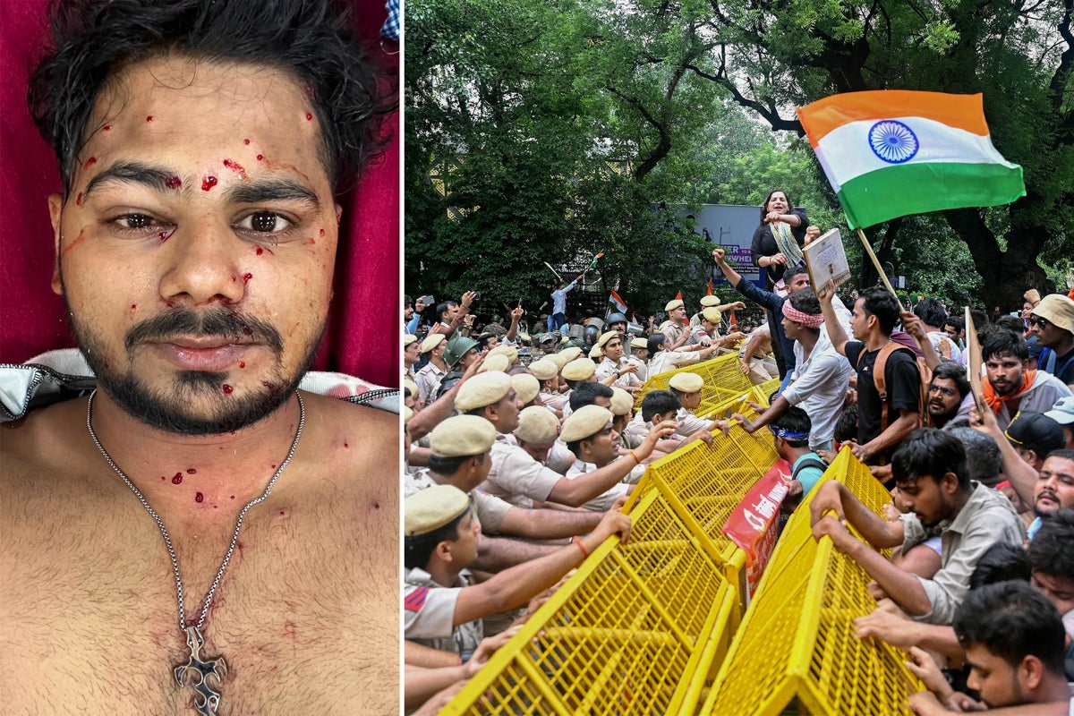 One may lose an eye, another will live with it forever: Delhi protesters describe life-altering injuries after pellet-gun firing