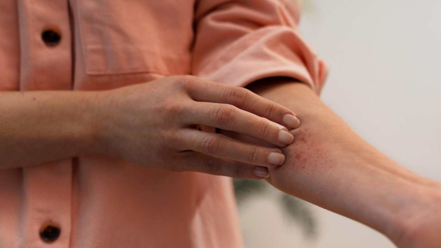 Prague Scabies Cases Rise as Health Officials Issue Advice