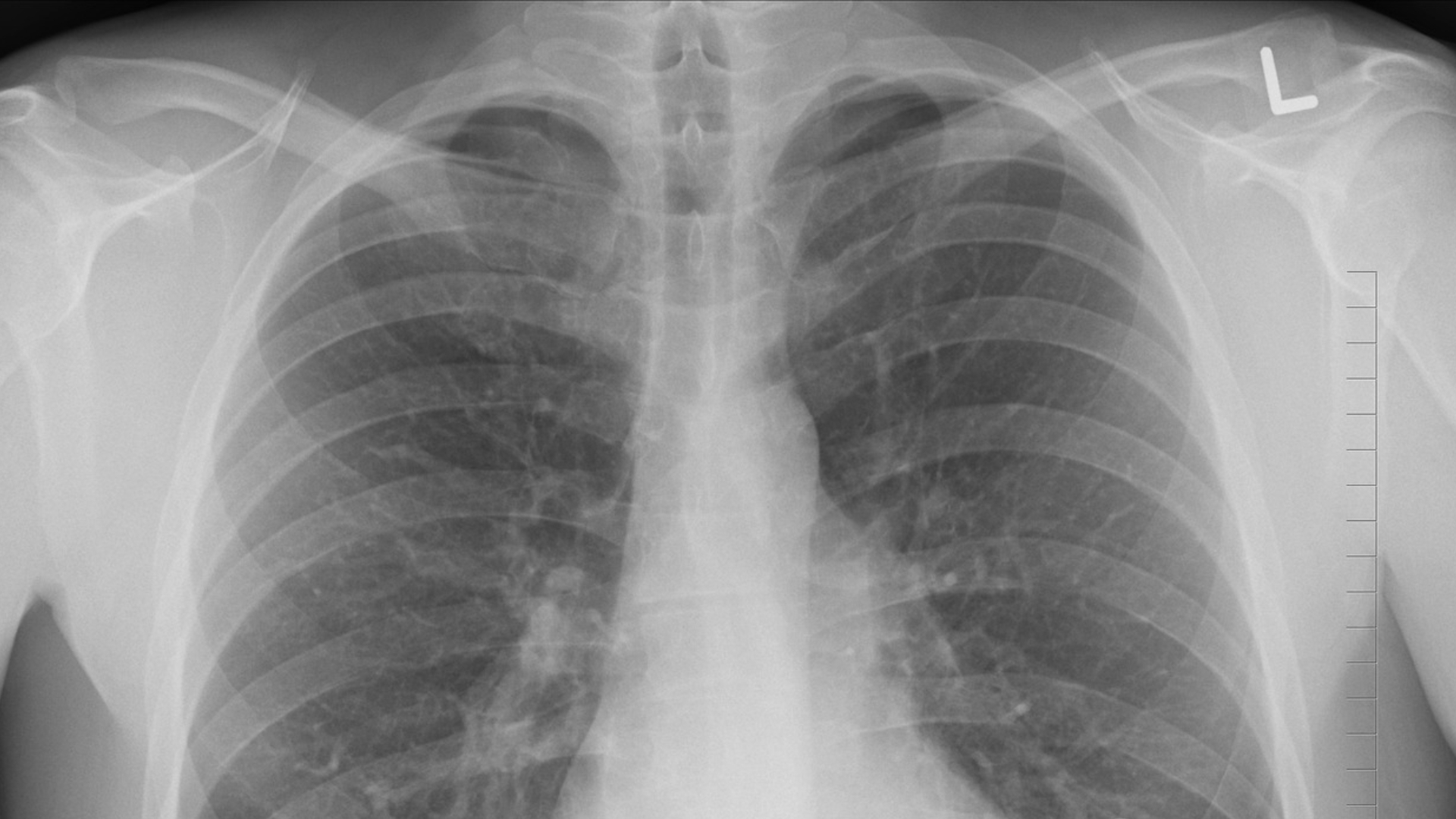 Russian doctors remove chicken bone from North Korean man’s chest