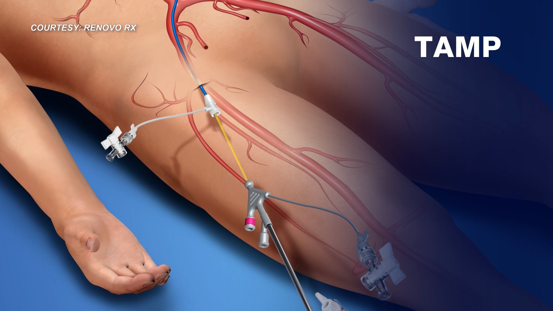 A new way to deliver chemotherapy shows less side effects, comes to Nebraska