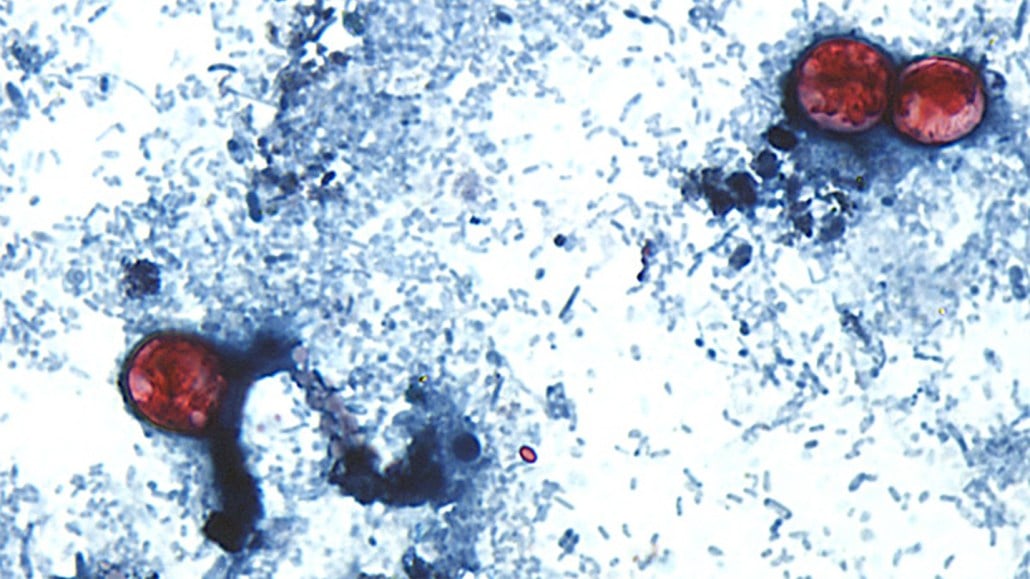 LLCHD confirms Cyclospora cases in Lancaster County are linked to national outbreak