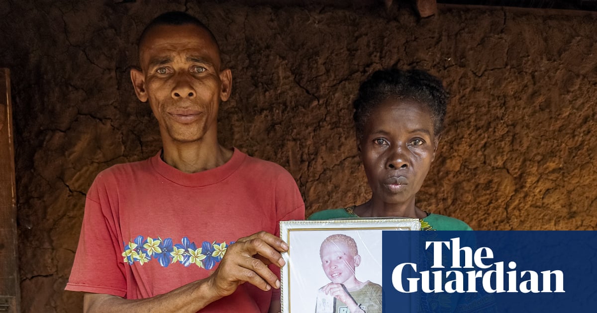 Murdered for their eyes: people with albinism living in terror in Madagascar | Global development