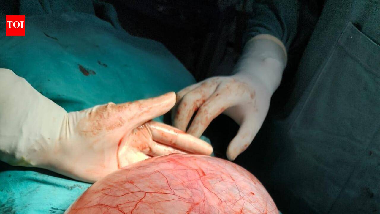 Doctors remove 3.5kg ovarian cyst | Prayagraj News